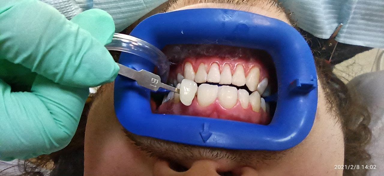 Після відбілювання зубів, Стоматологія Royal Dental