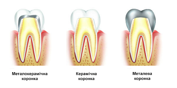 Види зубних коронок